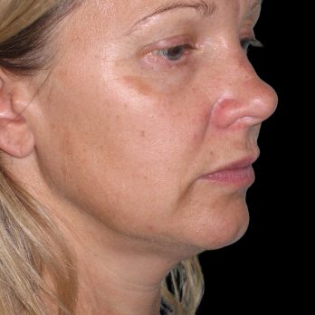 before-deep-plane-facelift